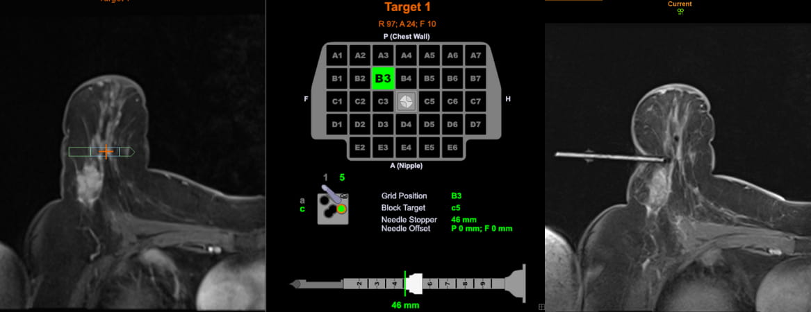 مستشفى جونز هوبكنز يكشف عن تقنية تصوير دقيقة لفحص وتشخيص سرطان الثدي