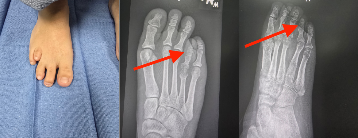 JHAH becomes first hospital in Eastern Province to offer routine toe-lengthening surgery for brachymetatarsia